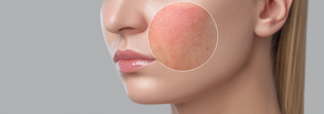 Allergie: Frau mit allergischer Reaktion im Gesicht