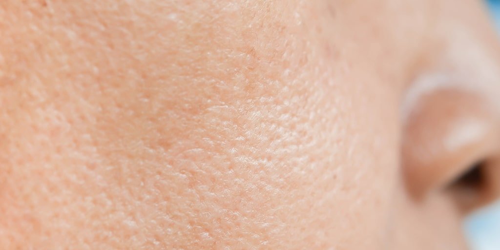 Larocheposay ArticlePage Acne All about acne and oily skin