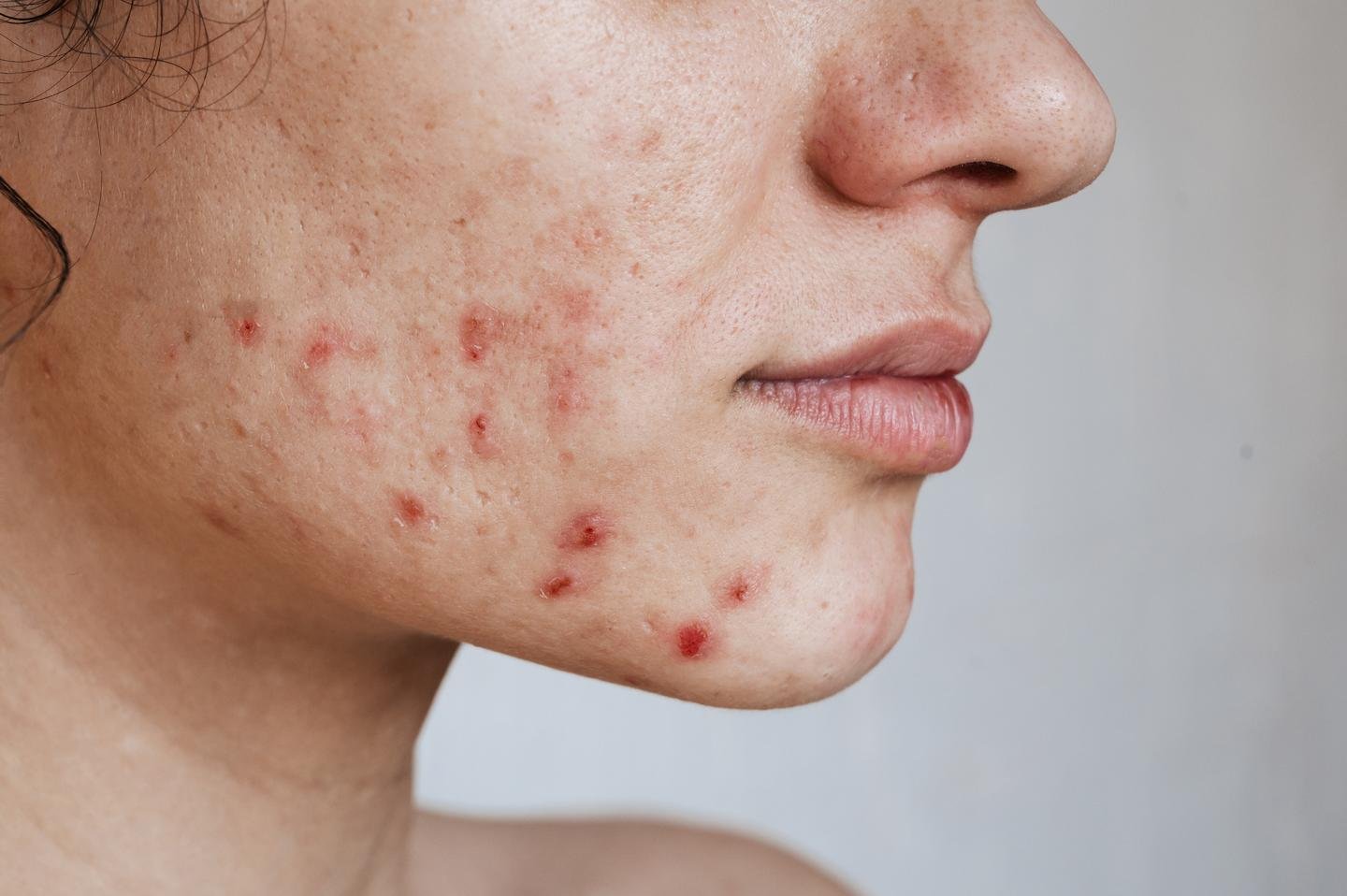 /sitecore/media library/Project/Loreal/Brand Sites/LRP/EMEA/DACH/Articles/Acne/Alles ueber Salicylsaeure bei Akne/24112025_LaRochePosay_AllesueberSalicylsaeurebeiAkne_Header