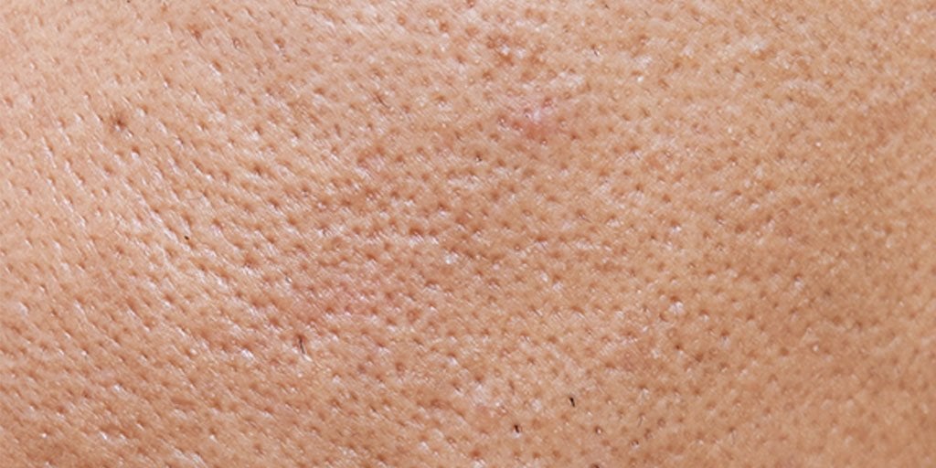 Larocheposay ArticlePage Acne How to get rid of blackheads