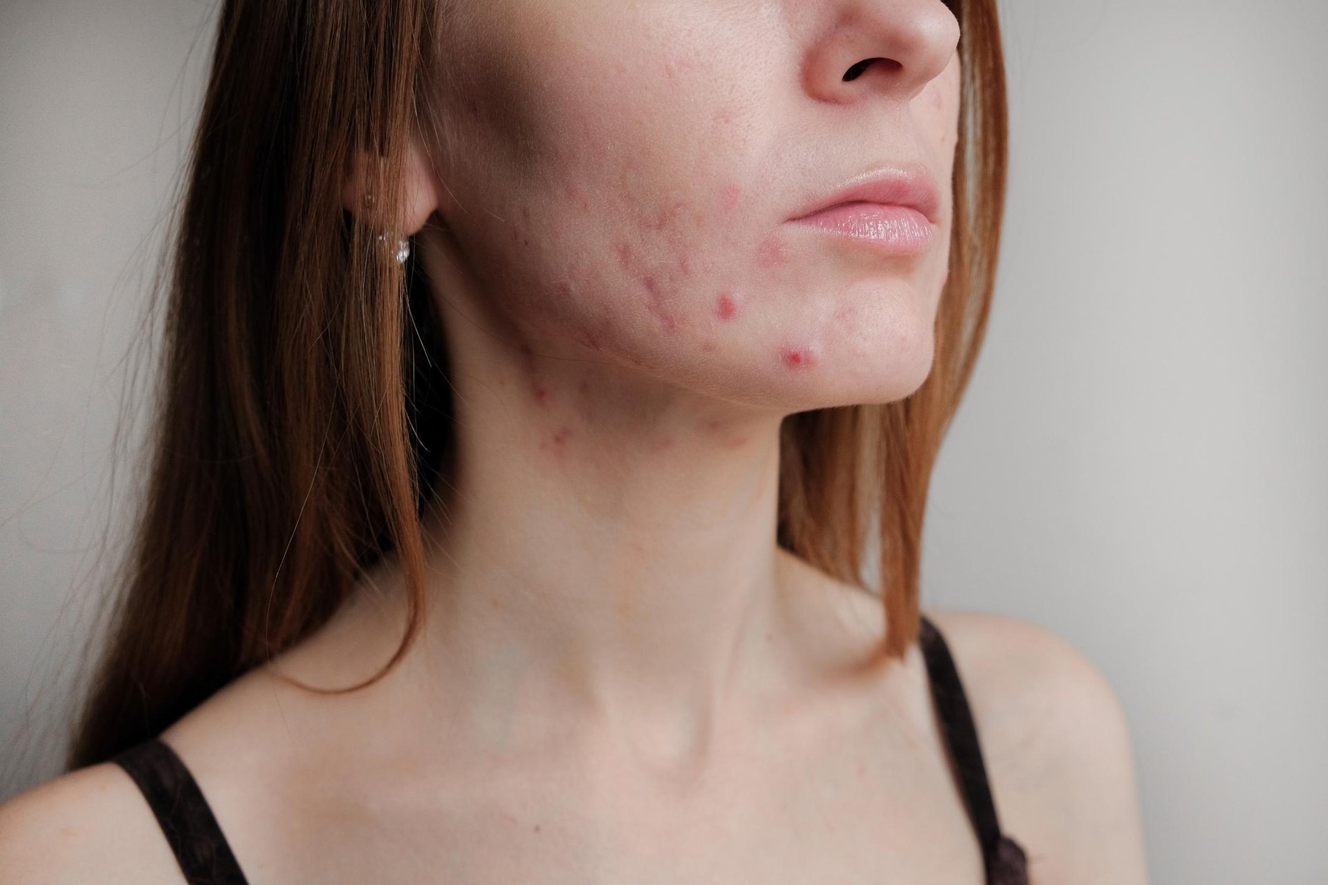 Pickel am Hals und an der Wange einer jungen Frau mit langen Haaren