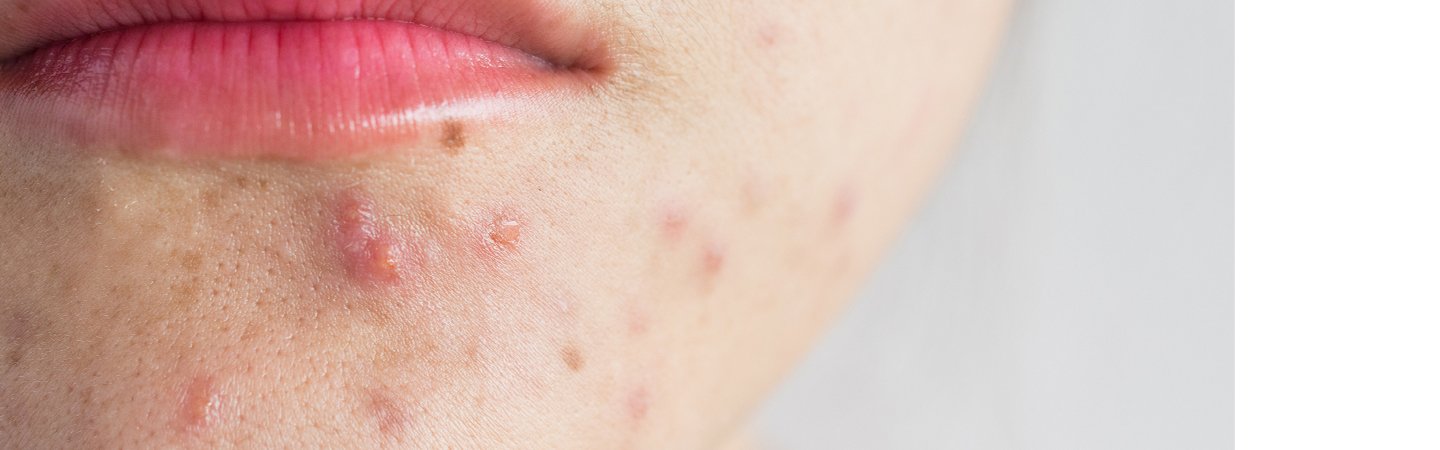 Nahaufnahme von Lippen und Kinn mit sichtbaren Hautunreinheiten. 