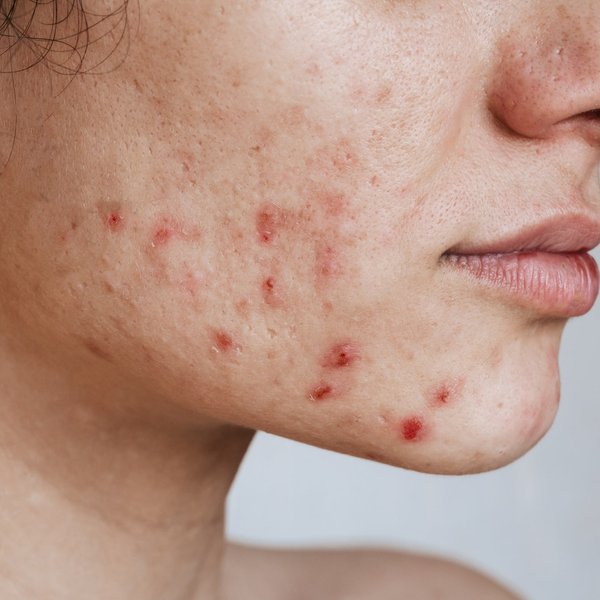 Unterirdische Pickel: Ursachen & Pflegetipps | La Roche Posay Unterirdische Pickel: Ursachen & Pflegetipps | La Roche Posay