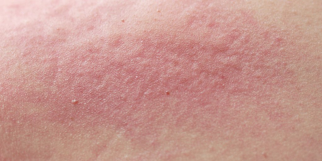 Larocheposay ArticlePage Allergic Only dry skin is reactive