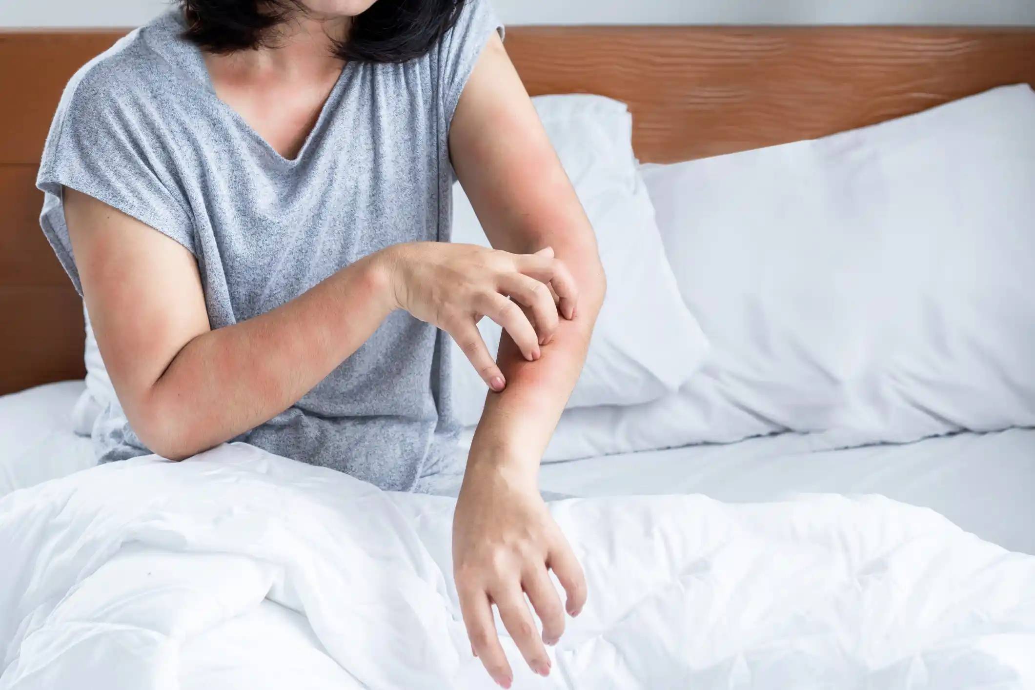 Milbenallergie: Allergische Hautreaktion im Bett