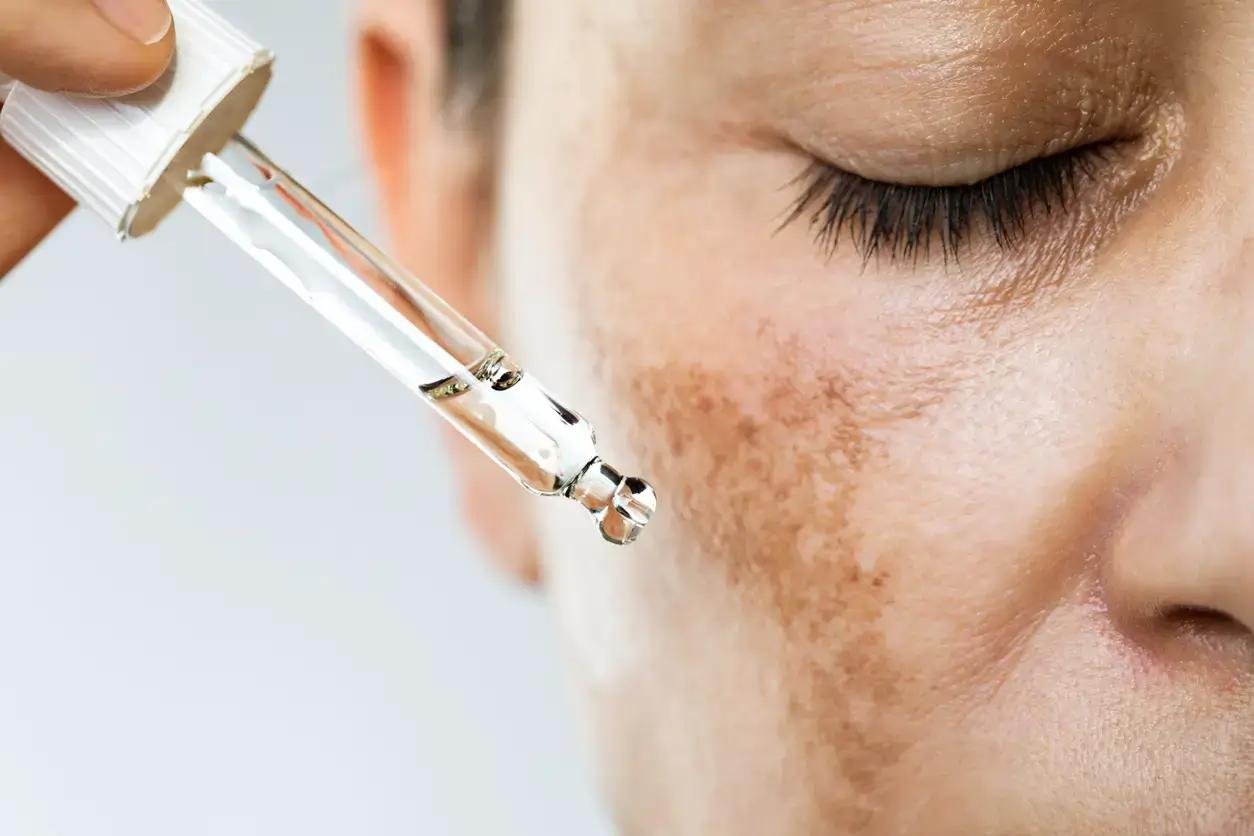 Pipette mit Serum nahe einer Wange mit Melasma