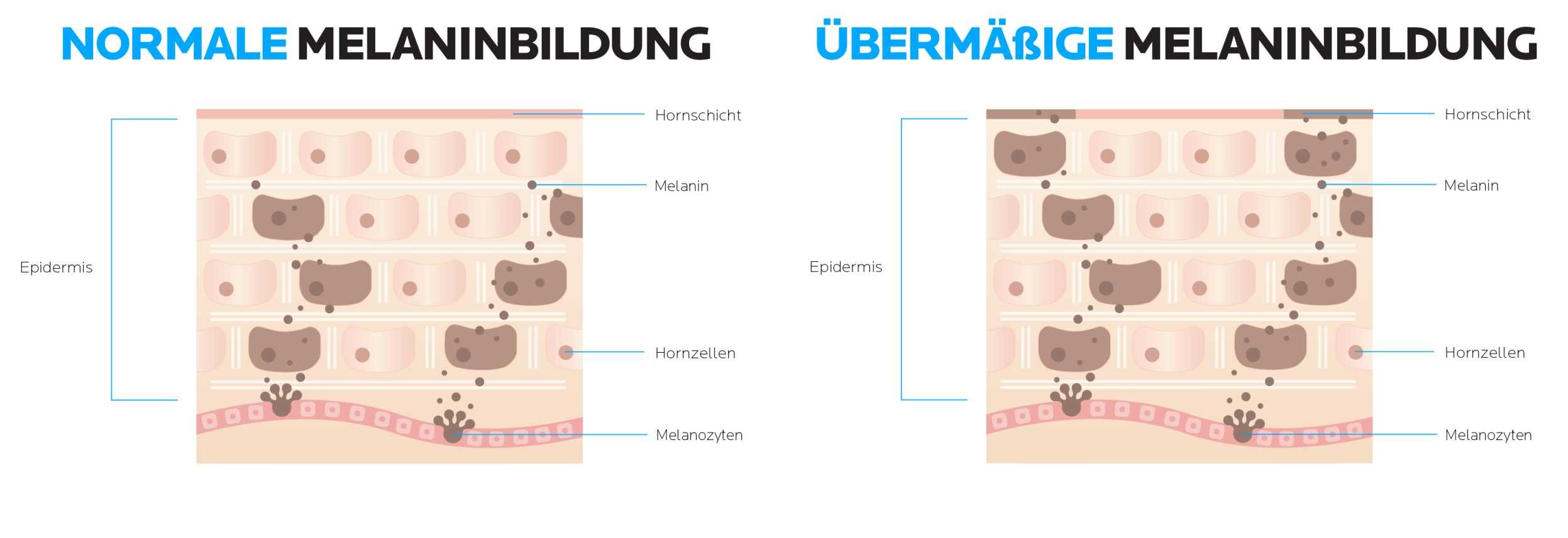 Detailbild Vergleich zwischen einer normalen und einer übermässigen Melaninbildung
