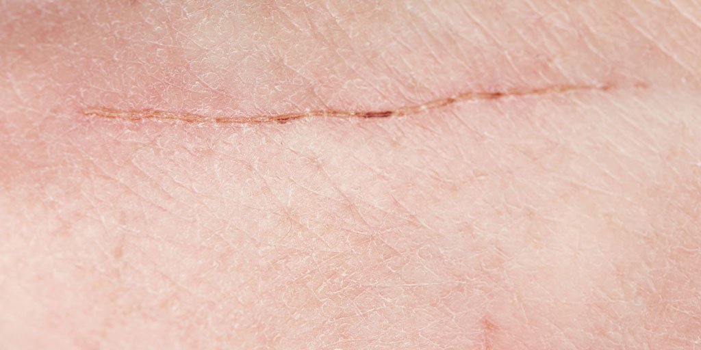 Larocheposay ArticlePage Damaged How to optimise scar healing