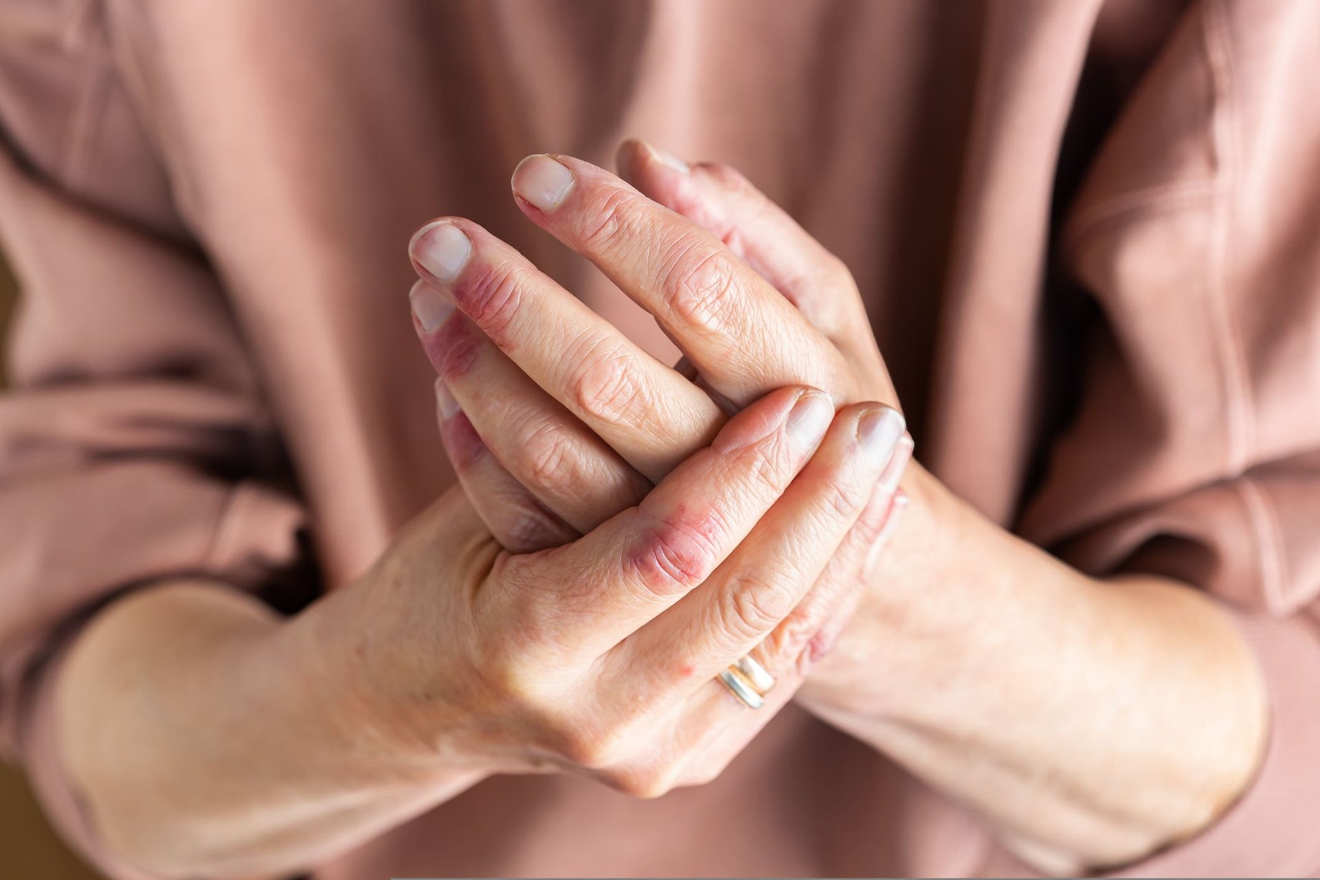 Frauenhände mit chronischer Dermatitis