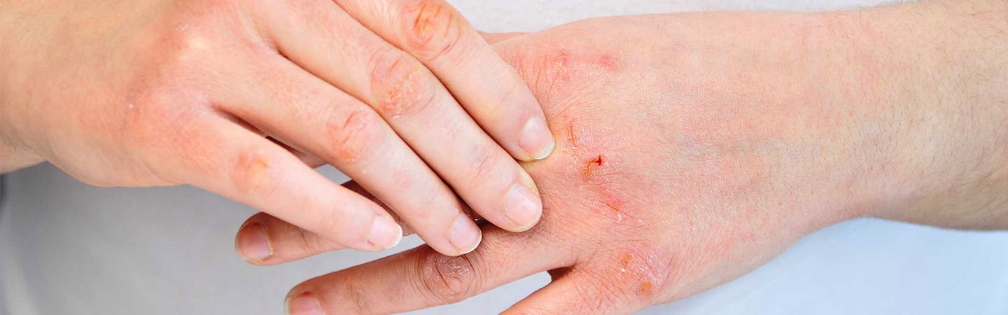Rissige Haut an den Händen: Austrocknungsekzem