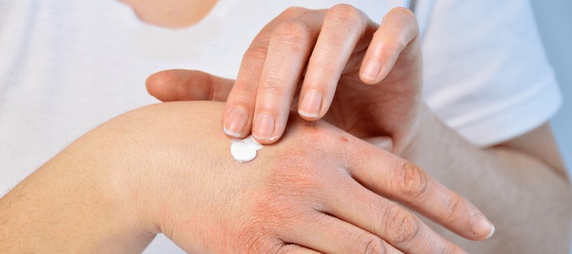 Cremen bei Neurodermitis