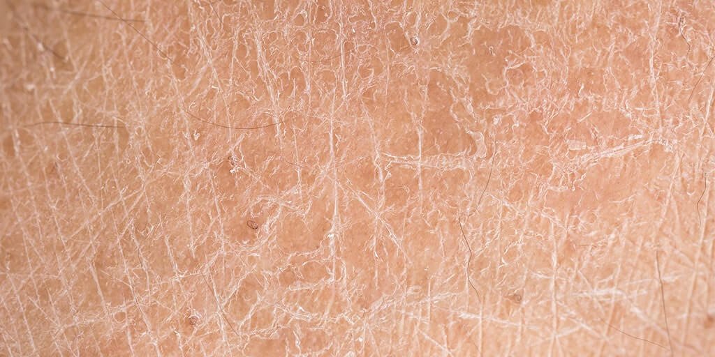 Nahaufnahme von extrem trockener Haut