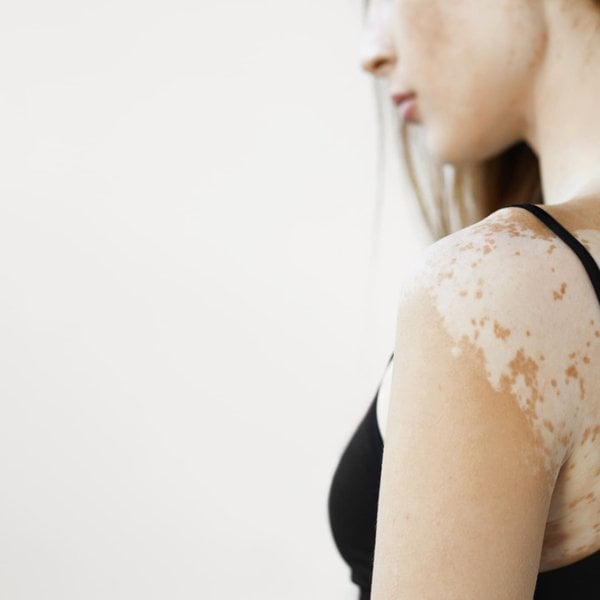 Frau mit Vitiligo (Weißfleckenkrankheit)