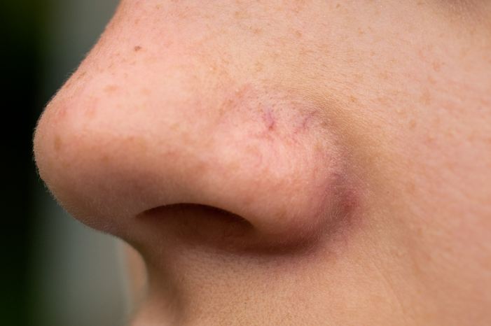 LaRochePosay-ArticlePage-Sensitive-Couperose-Nose