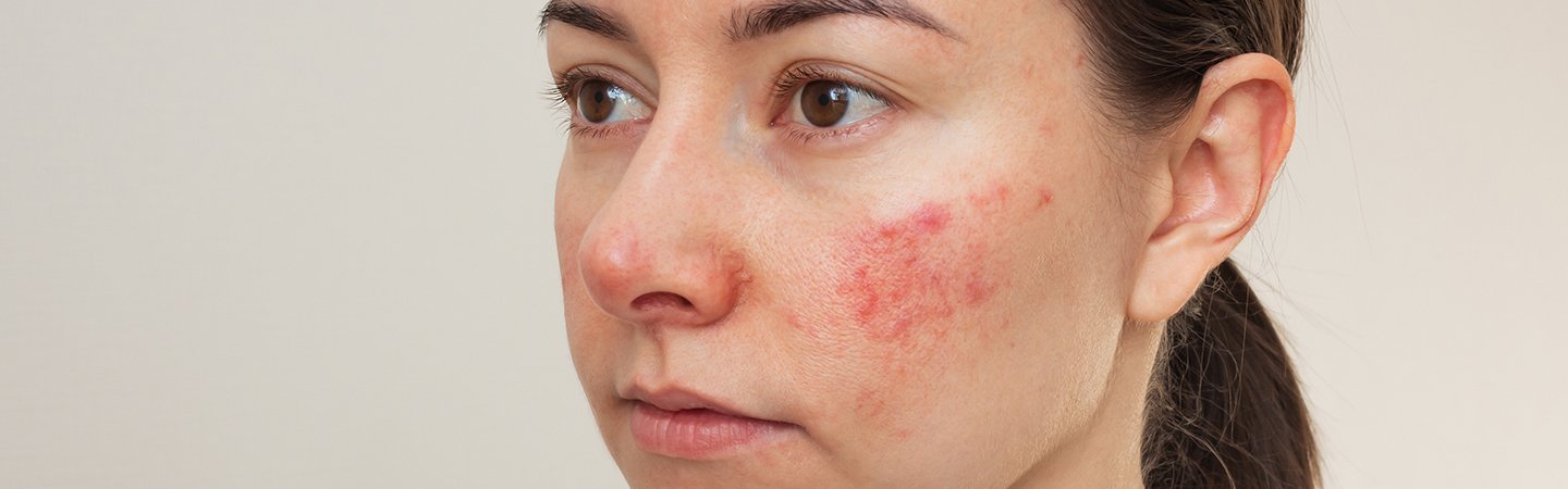 Hautbild mit Rötungen (Erythrose) und Symptomen von Rosazea.