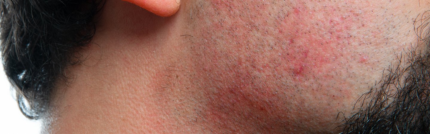 Nahaufnahme eines männlichen Gesichts mit geröteter Haut durch Rasurbrand. 