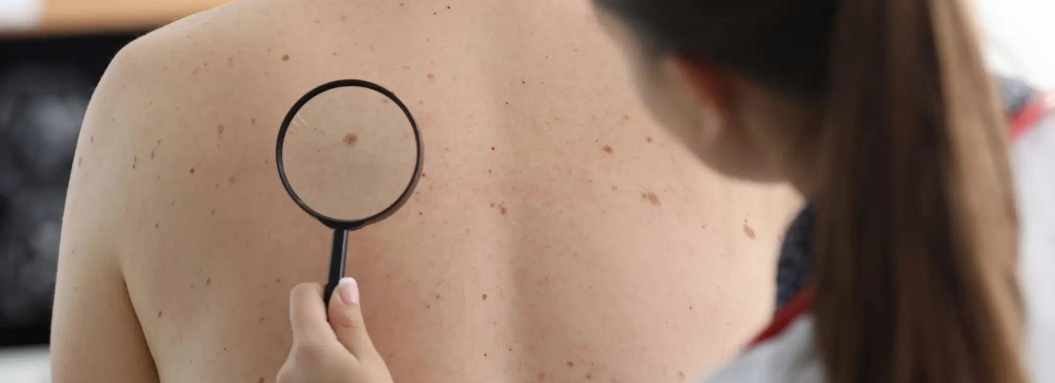 Das bedeuten braune Flecken auf der Haut La Roche Posay