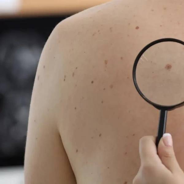 Das bedeuten braune Flecken auf der Haut | La Roche Posay