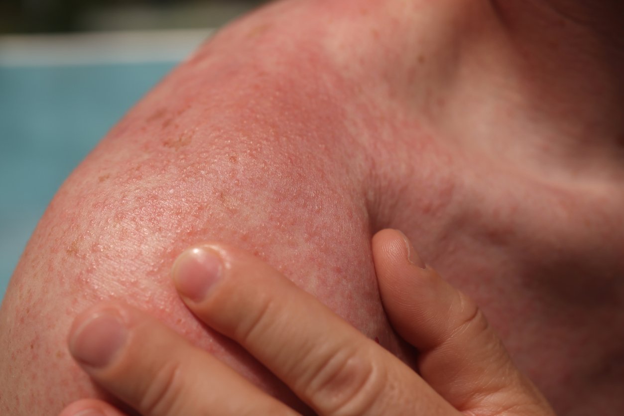 Antibiotikum und Sonne: Rote Haut mit Bläschen auf der Schulter