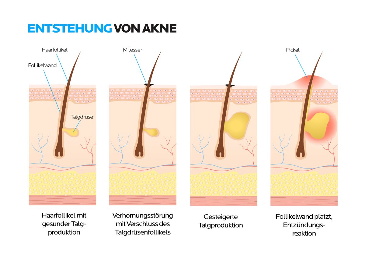 Die Entstehung von Akne, Pickeln und Mitessern