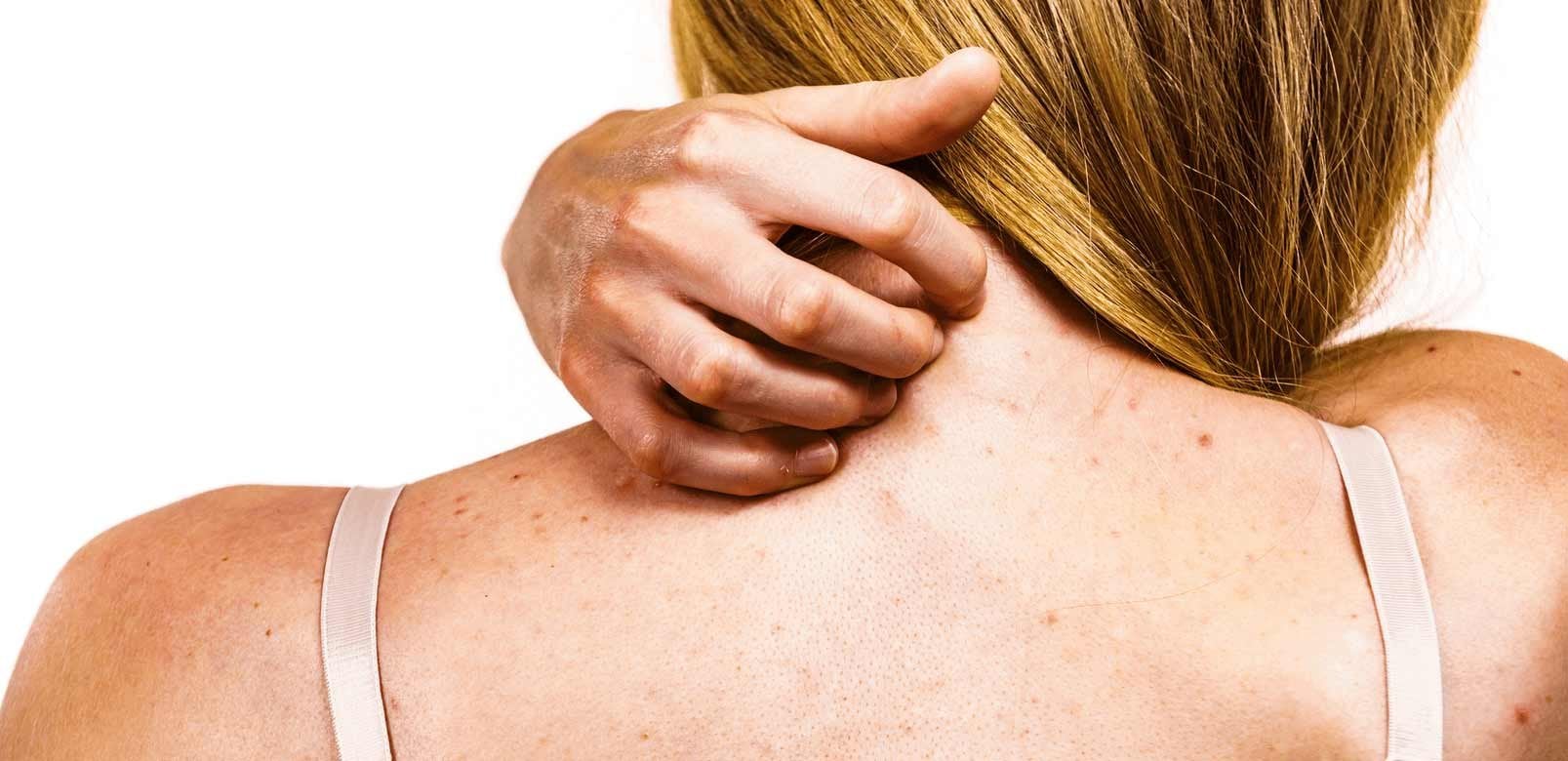 Frau mit zu Akne neigender Haut kratzt sich am Rücken