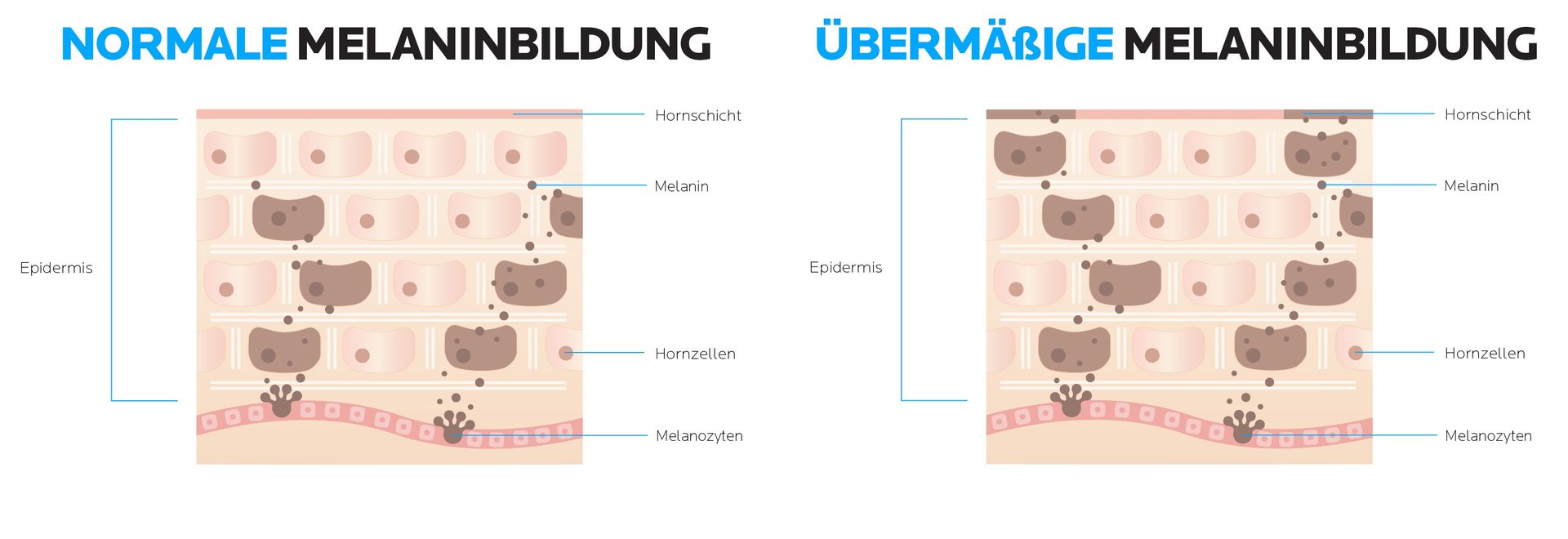 Darum entstehen Pigmentflecken: normale vs. übermässige Melaninbildung
