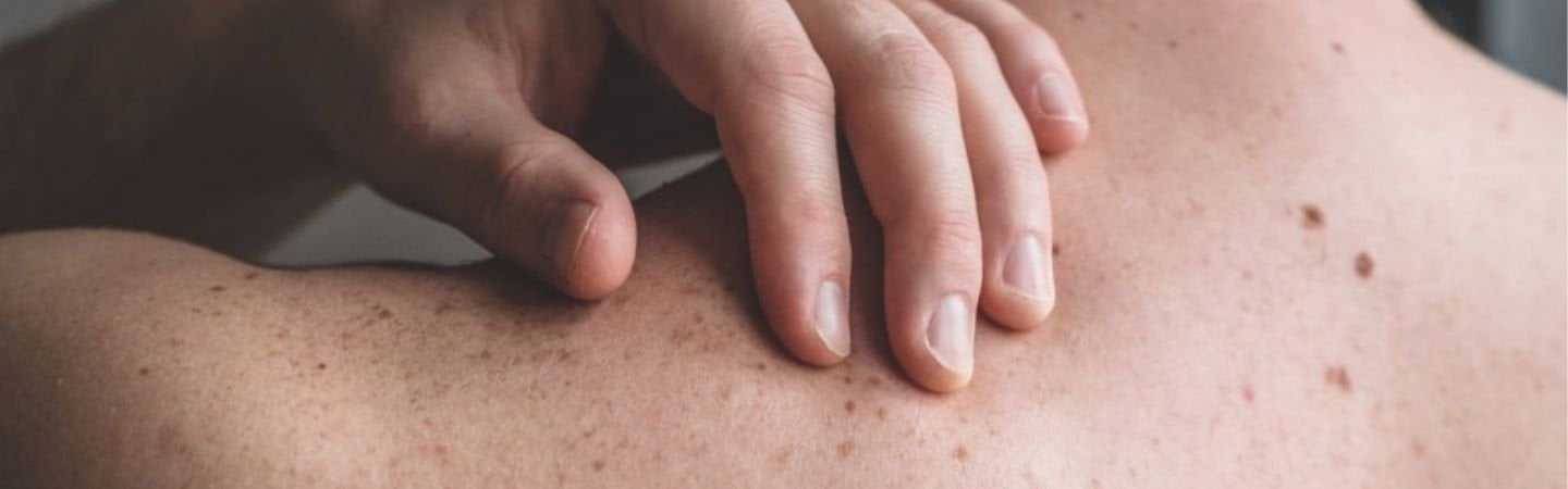 Pigmentflecken auf dem Rücken