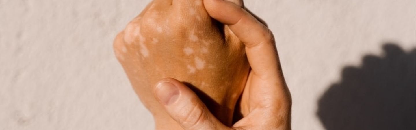 Vitiligo (Weißfleckenkrankheit) an den Händen