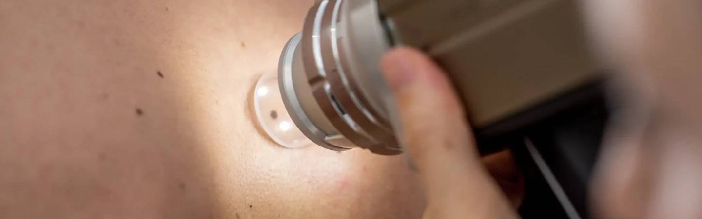 Laserbehandlung bei aktinischer Keratose