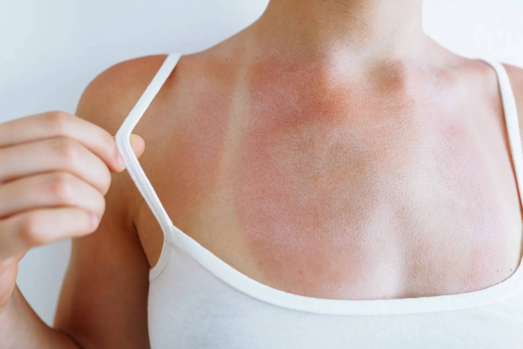 Sonnenbrand