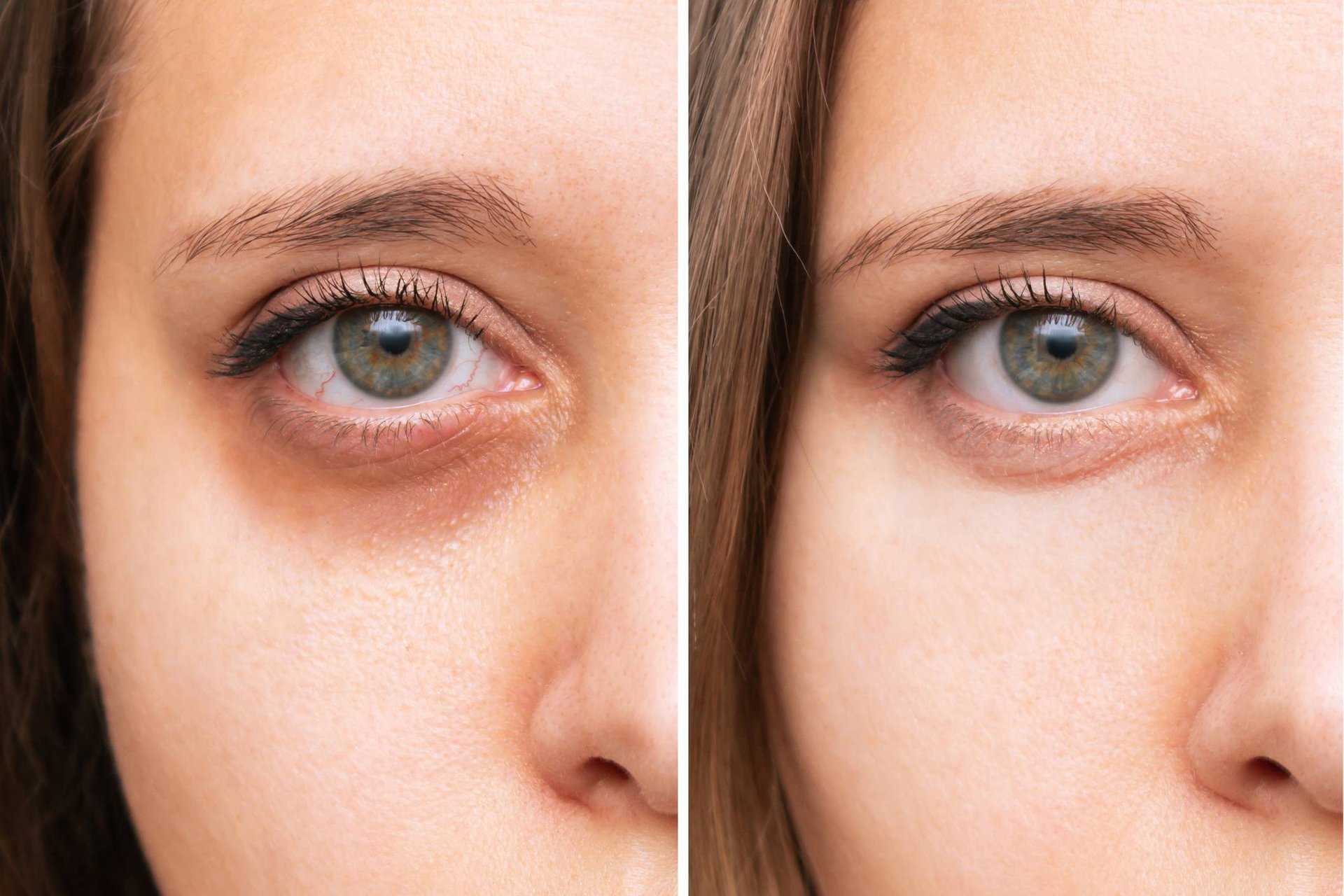 Vergleich von 2 gleichen Augen mit und ohne Augenringe
