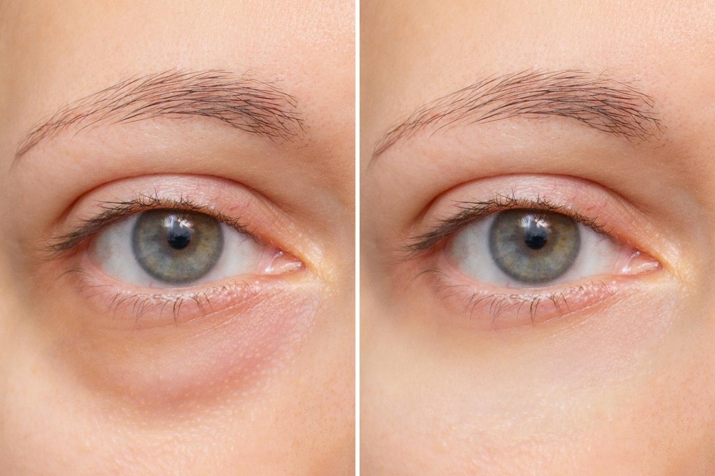 Das gleiche Auge ist zweimal zu sehen. Einmal mit und einmal ohne Augenringe