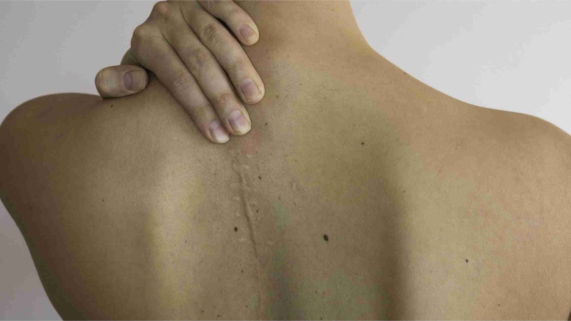 Haut mit einer erhabenen Narbe nach einer Operation