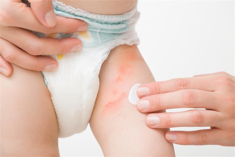 Creme auf Windelausschlag am Oberschenkel eines Babys auftragen