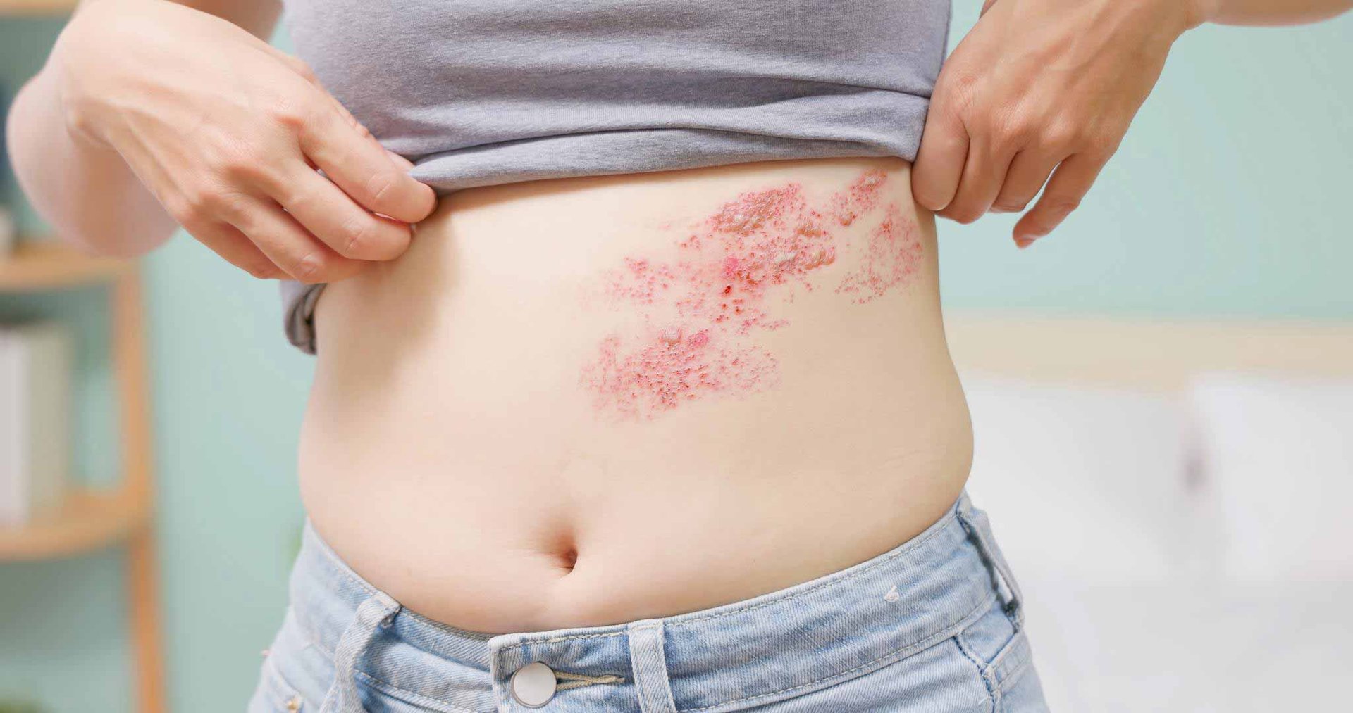 Frau hebt ihr graues Top an, um eine große Stelle mit verkrusteter Gürtelrose an ihrer linken Bauch-Hälfte zu zeigen