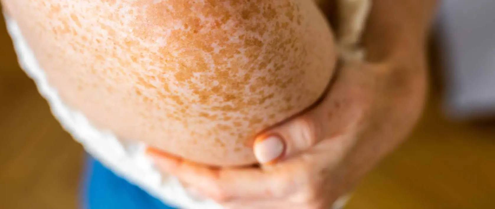 Melanin: Verantwortlich für Sommersprossen auf der Haut