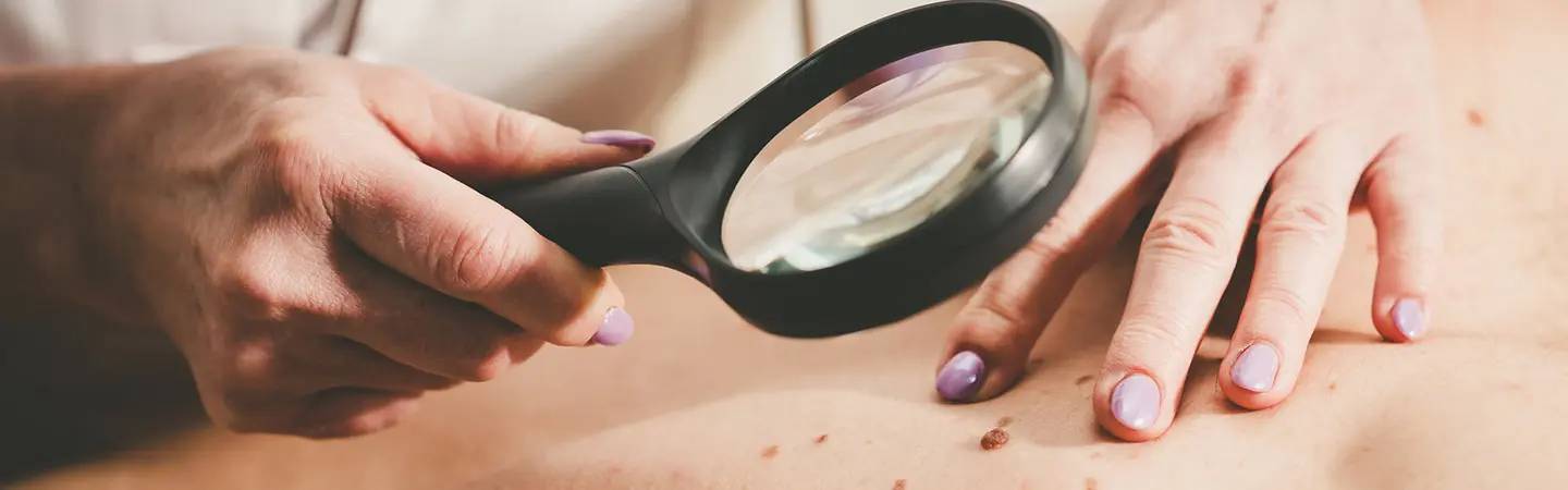 Dermatologe untersucht Muttermal auf dem Rücken