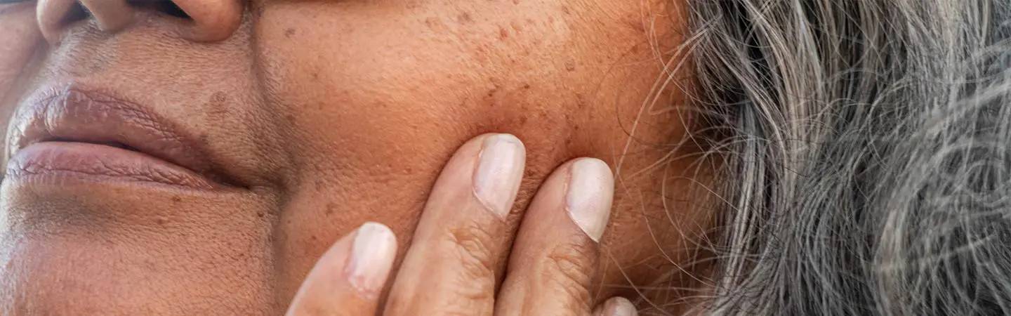Ältere Frau mit Muttermalen im Gesicht