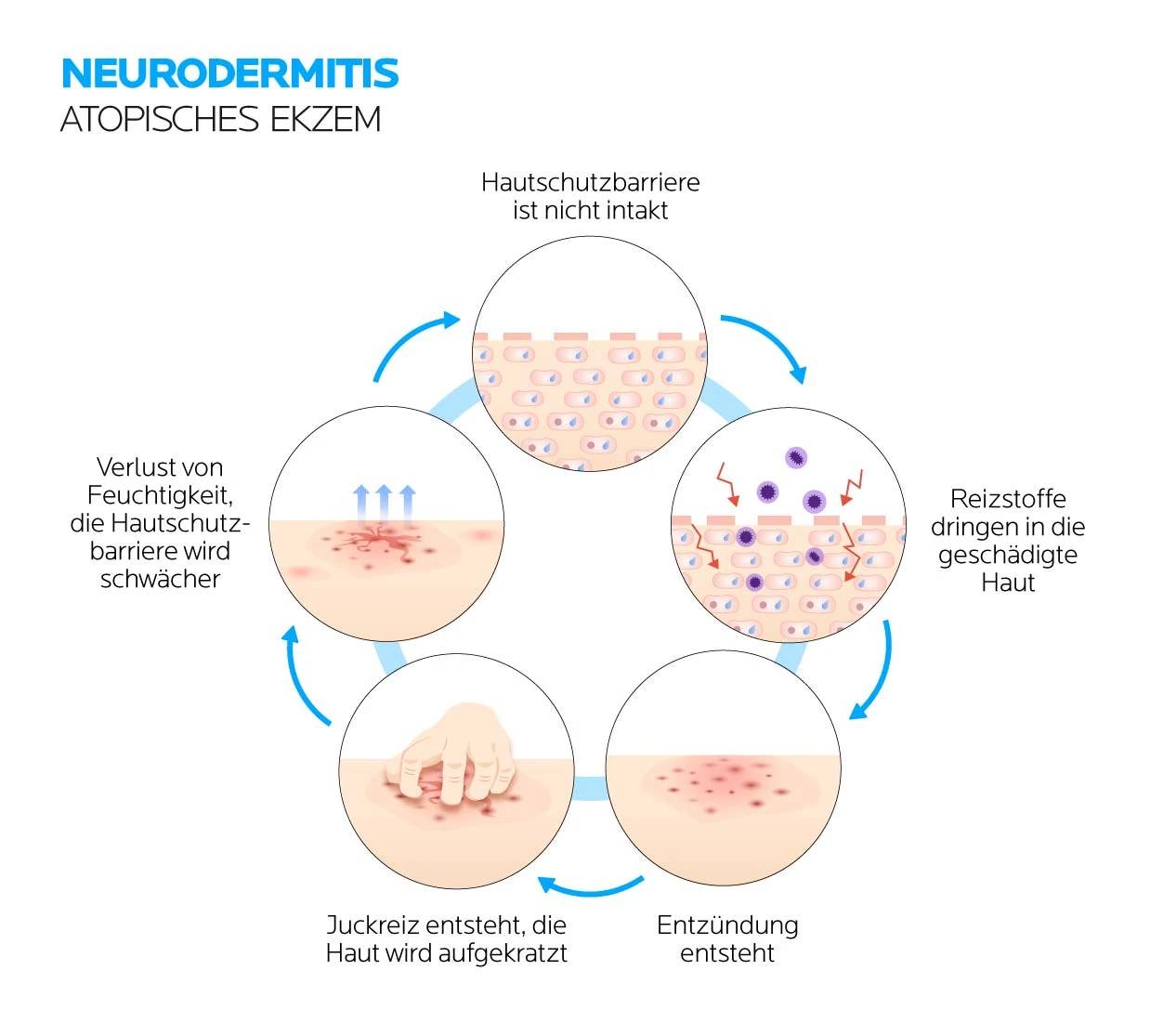 Neurodermitis und Juckreiz: Ein Teufelskreislauf