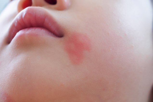 Hautpflege bei perioraler Dermatitis | La Roche Posay
