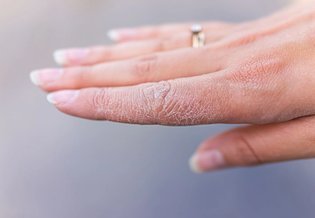Trockene Hände: Rissige Haut an den Fingern