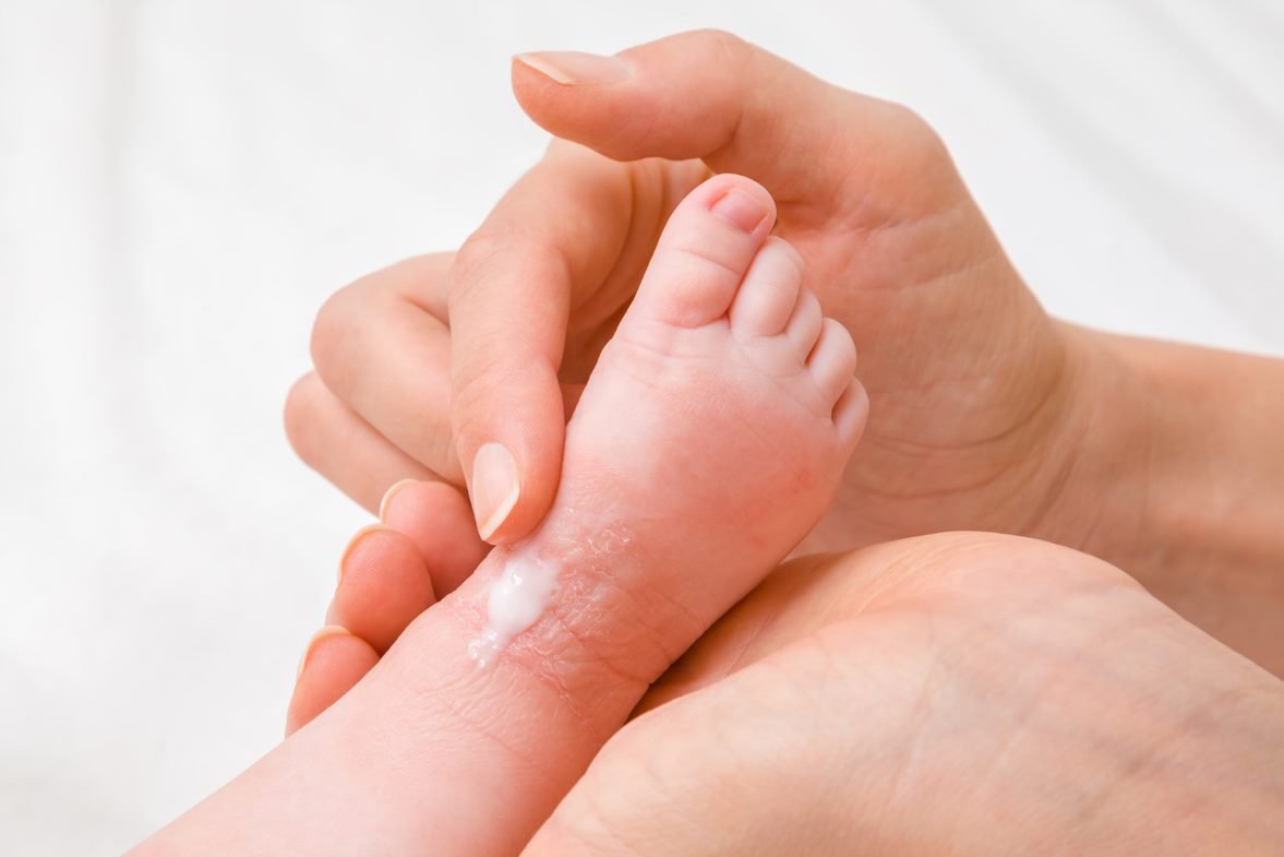 Trockene Haut bei Babys