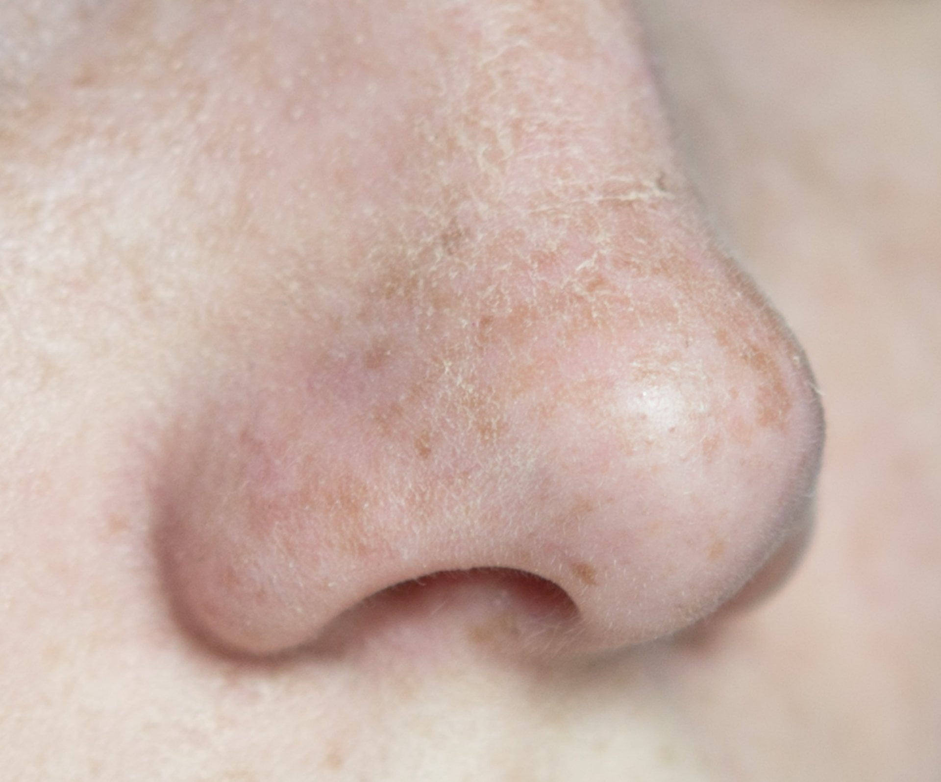 Nahaufnahme einer Nase mit trockener Haut auf dem Nasenrücken