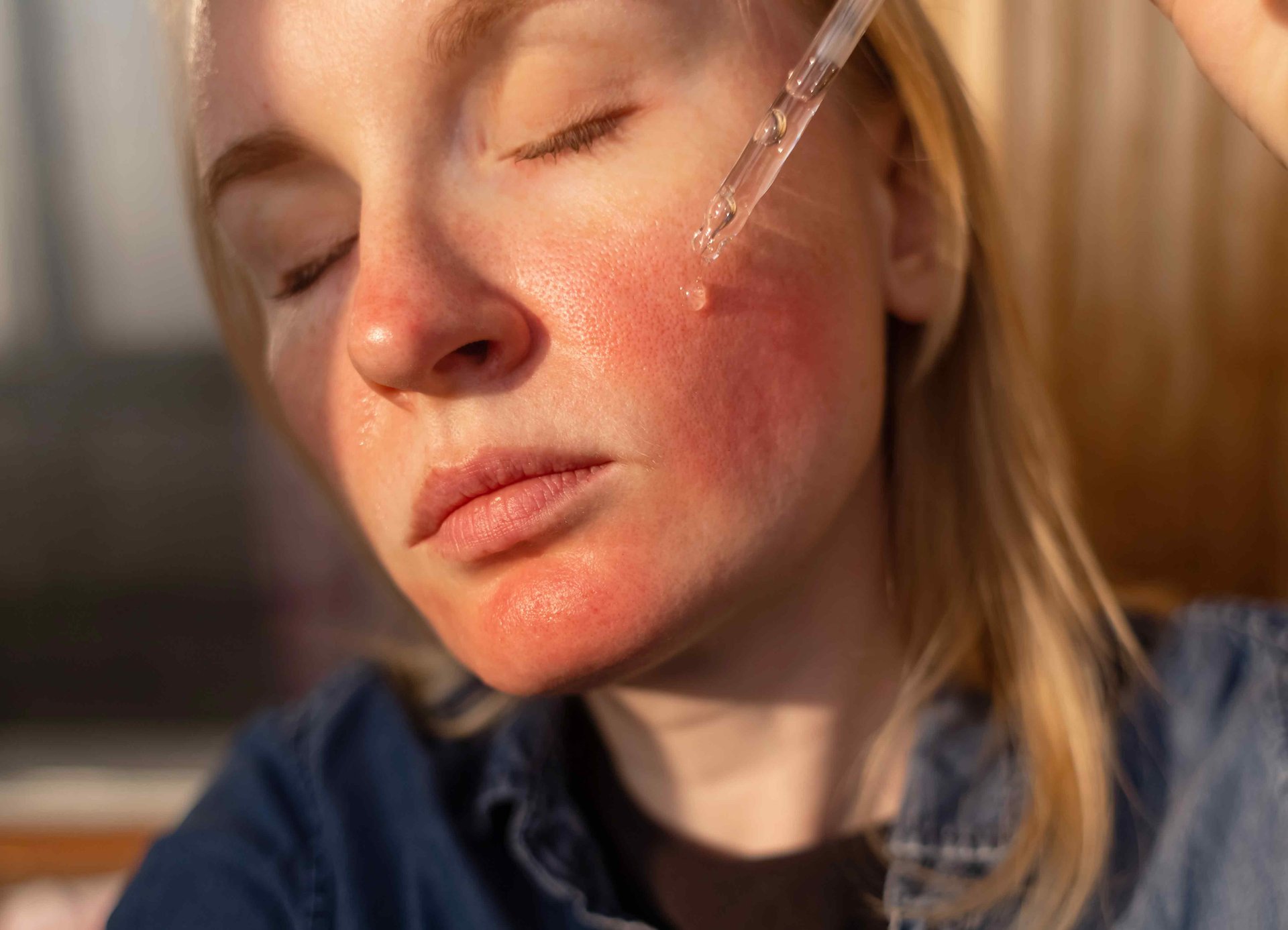 Gereizte Gesichtshaut nach dem Auftragen eines Serums mit möglicher Retinol-Reizung