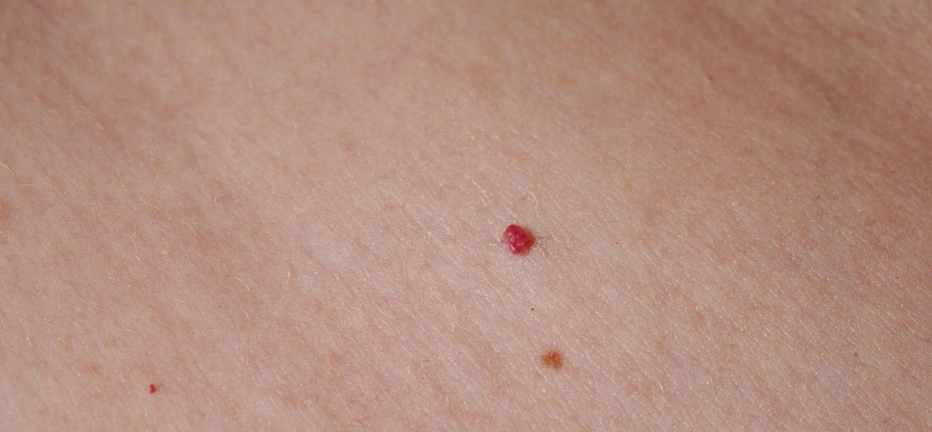 Hautstelle mit Rubinfleck und weiteren Pigmentflecken