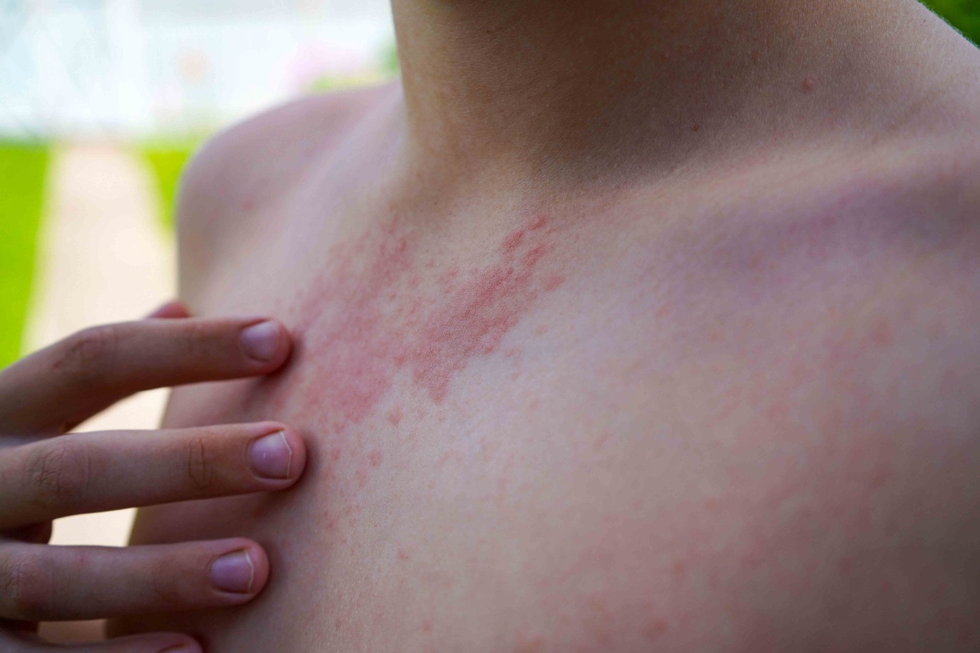 Sonnenallergie-Hautausschlag im oberen Brustbereich eines Kindes