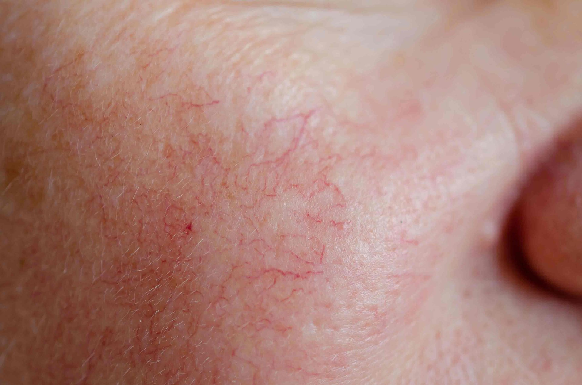 Rosazea im Gesicht