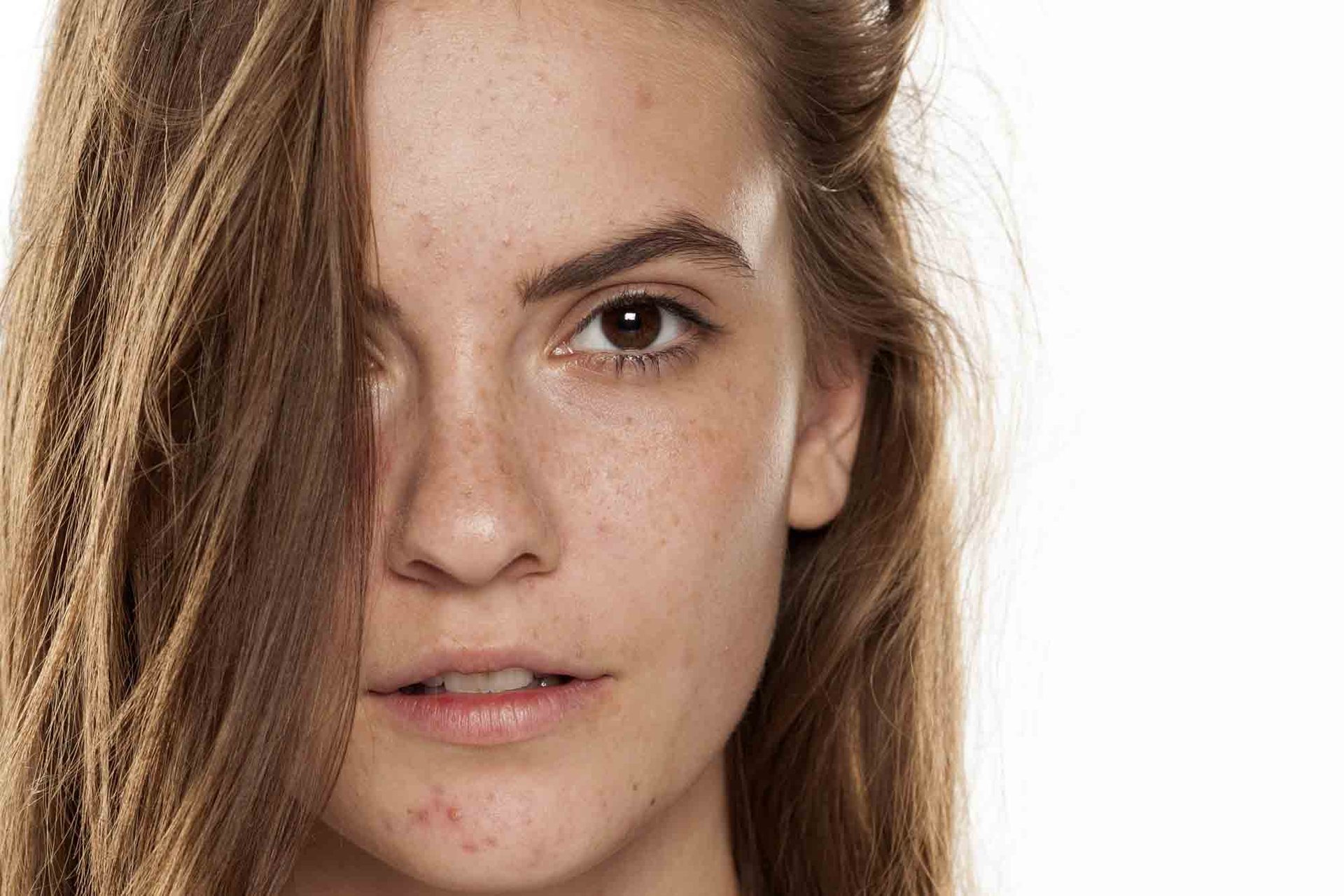 Unreine Haut im Gesicht einer Frau