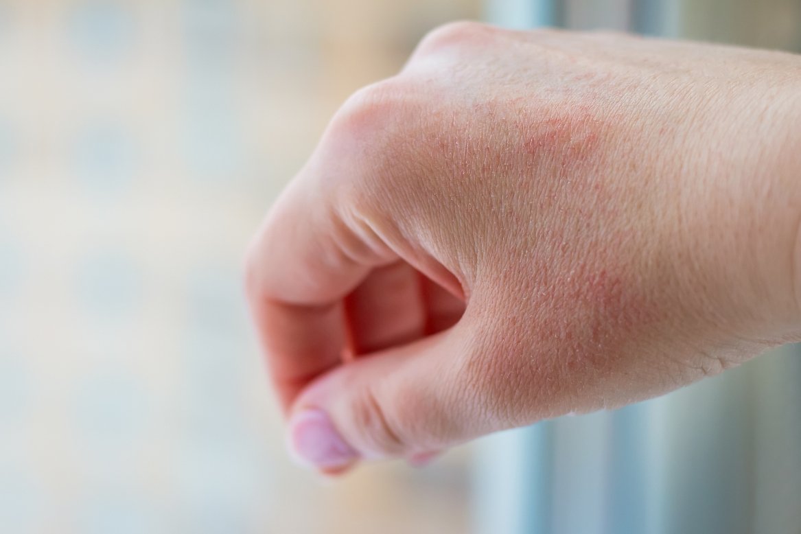 Trockene Haut/Neurodermitis auf der Hand
