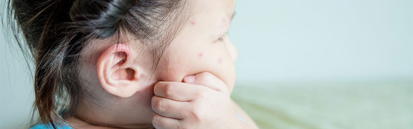 Larocheposay ArticlePage Eczema Dont scratch